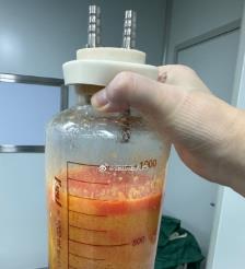 长兴水动力吸脂手术要做多久？